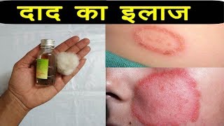 दाद खुजली को खत्म करने का आसान उपाय  Daad Ka Gharelu Upay  Daad Ka Ilaj Ringworm Treatment दाद [upl. by Nakre]