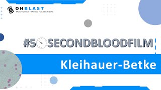 50SecondBloodFilm​ KleihauerBetke test [upl. by Evvie]