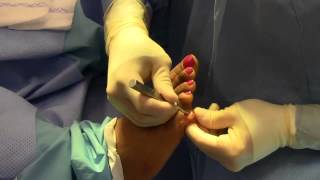 Hammer Toe 5th Digit Surgery  Dr Nagler [upl. by Nnaeel]