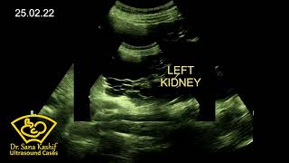 Polycystic Liver amp Kidneys ADPKD Sonographic description ardms asum crgs [upl. by Dyrraj]