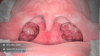 3D Medical Illustration of Tonsils  Tonsillitis Animation  ENT Animation [upl. by Iggem627]