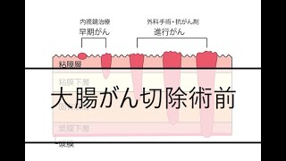 1分で見る疾患別看護計画！大腸がん切除術前 [upl. by O'Connor87]