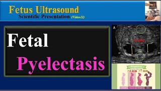 Pyeloplasty [upl. by Towers]