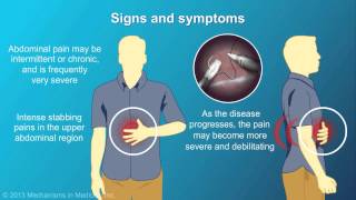 Chronic Pancreatitis [upl. by Cummins959]