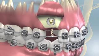 Impacted Tooth Exposure amp Uncovering For Orthodontics [upl. by Mont]