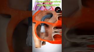 3D Transcatheter mitral valve replacement😱😲💯 demonstration heart health 3d shorts [upl. by Bonina]