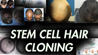 Stem Cell Hair Cloning Current and Future Treatments for Androgenetic Alopecia [upl. by Shandy]