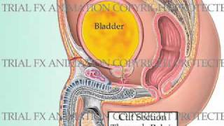 Urinary Bladder Injury Animation [upl. by Washko]