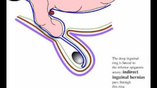 Direct and indirect inguinal hernia [upl. by Puritan78]