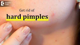 How to get rid of hard pimples  Dr Urmila Nischal [upl. by Julius461]