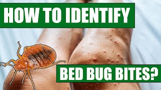 How To Identify Bed Bug Bites  Can Doctors or Exterminators Identify Bed Bug Bites [upl. by Schulein]