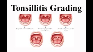 Tonsillitis Grading [upl. by Atalanta]