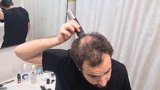 BALDING In My 20s  Shaving My Head amp Accepting Going Bald [upl. by Loreen]