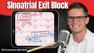 Sinoatrial SA Exit Block EKG  ECG Lecture [upl. by Nylanej429]