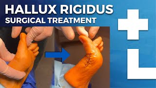 Hallux rigidus surgery  cheilectomy Moberg osteotomy  Dworska hospital® [upl. by Ziegler]