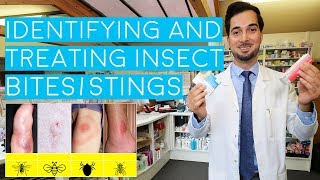 Insect Bites and Stings  Insect Bites Treatment  How to Treat Insect Bites and Stings  2018 [upl. by Berry852]