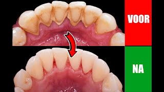 Zo verwijder je tandplak van je tanden zonder naar de tandarts te gaan [upl. by Nezam901]