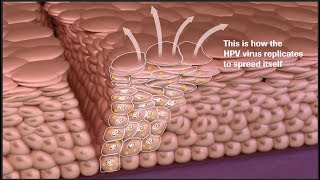 Cervical Cancer Disease Progression and Prevention Screen Manage and Diagnose More Accurately [upl. by Akcemat418]