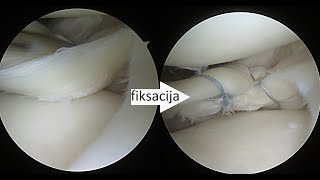 Išorinio menisko ir kryžminio raiščio rekonstrukcija Lateral meniscus repair complex with ACLR [upl. by Aliehs]