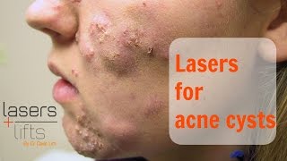 Pico Lasers for skin conditions Dermatologist reviews [upl. by Licec]