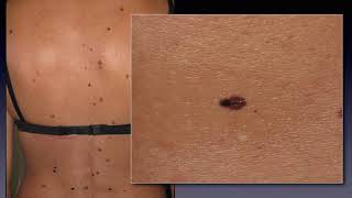 Dermoscopy for skin cancer screening  Dr Claudio Conforti [upl. by Ahcsropal]