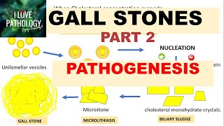 CHOLELITHIASIS GALL STONESPart 2 Pathogenesis Morphology Clinical FeaturesComplications [upl. by Spector]