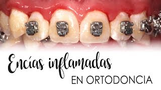 ENCÍAS INFLAMADAS CON ORTODONCIA  CAUSAS Y TRATAMIENTO [upl. by Pacifa399]