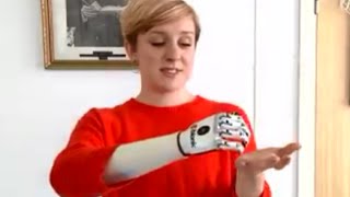 bionic hand UK user receives ‘world’s most lifelike’ bionic hand [upl. by Jerz510]