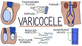 Varicoceles [upl. by Keily]