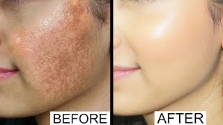 HYPERPIGMENTATION amp ACNE SCARS  Anaysa [upl. by Aihcela109]