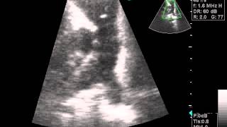 Pulmonary Thromboembolism [upl. by Valeta]