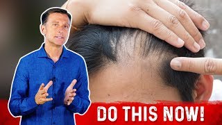 Receding Hairline Causes And Remedies – DrBerg [upl. by Cindy]