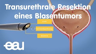 TURBT  Transurethrale Resektion eines Blasentumors [upl. by Pompei]