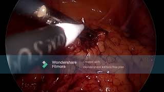 LAPAROSCOPIC APPENDECTOMY [upl. by Esilehs]