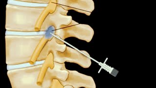 Selective Nerve Root Blocks in Spine Surgery [upl. by Aneehsak]