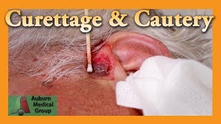 Curettage and Cautery for Basal Cell Carcinoma  Auburn Medical Group [upl. by Enelia]