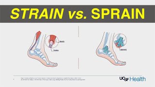 Strain vs Sprain Treatment [upl. by Ecnerret852]