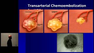 Hepatocellular Carcinoma Optimal Treatment and Transplantation [upl. by Nonnairb7]