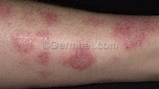 Varicose Eczema  7 Facts About Varicose Eczema You Must Know [upl. by Ennagrom]