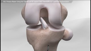 ACL Primary Repair Using the TightRope® RT Implant With InternalBrace™ Ligament Augmentation [upl. by Atillertse]