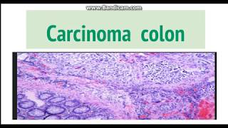 Carcinoma colon Pathogenesis Morphology and clinical features [upl. by Eixor]