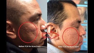 TCA CROSS for acne scarring  TCA Cross treatment for ACNE SCARS [upl. by Yaner]