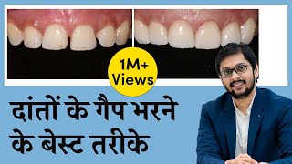 दाँतो के बीच की गैप को कैसे ठीक करें  CloseFill Gap In Teeth  Seraphic Dental Indore  Dr Ankit [upl. by Marylee]