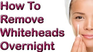 How To Remove Whiteheads Overnight  1 REMEDY To Remove Whitehead [upl. by Lyrred]