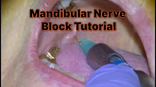 1 How to Administer a Mandibular Nerve Block [upl. by Ahsinauj]