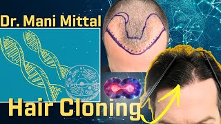 Dr Mani Mittal Hair Cloning Verteporfin Stem Cells Hair Transplant Artistry [upl. by Amalberga25]