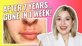 How I Cured My Eczema Cheilitis Contact Dermatitis Lip Rash Once amp For All after 7 Years [upl. by Dworman]