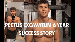 Pectus Excavatum  6 Year Successful Transformation Without Surgery [upl. by Dace445]