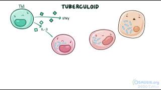 Mycobacterium Leprae  Leprosy  Osmosis [upl. by Reinwald]