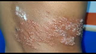 Shingles  Daily Dos of Dermatology [upl. by Akeber]